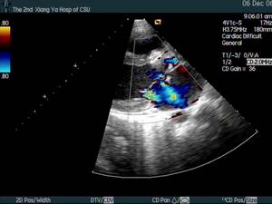 亞急性感染性心內膜炎
