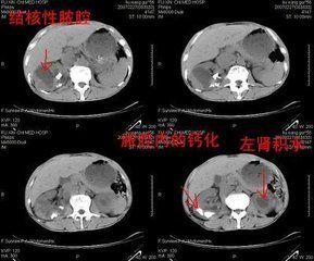 腎結核對側腎積水 腎結核對側腎積水