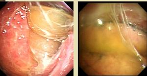 （圖）腫瘤外觀