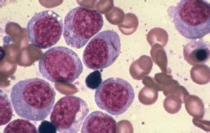 慢性淋巴細胞白血病  