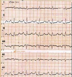 心電圖 P波增高