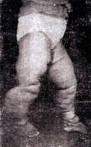 淋巴絲蟲病 淋巴絲蟲病