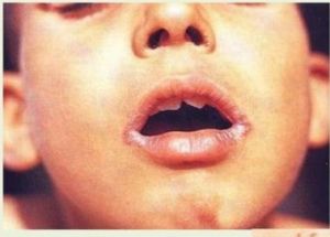 維生素B2與口角炎