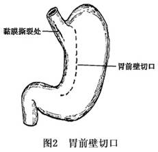 賁門黏膜撕裂綜合徵