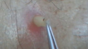 人膚蠅感染後的症狀