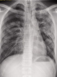 肺部小結節