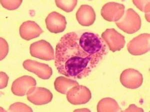 外陰顆粒性肌母細胞瘤 外陰顆粒性肌母細胞瘤