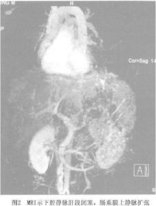 巴德-恰里綜合徵
