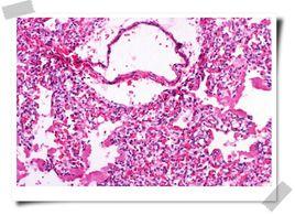 肺透明膜病 肺透明膜病