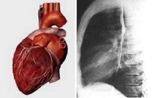 非特異性間質性肺炎