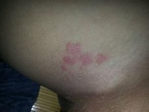 落磯山斑點熱 落磯山斑點熱