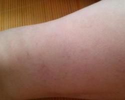 毛細血管擴張症