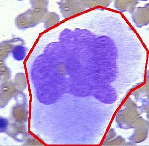血栓性血小板減少性紫癜