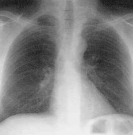 潘科斯特綜合徵 潘科斯特綜合徵