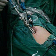 腹腔積水 腹腔積水