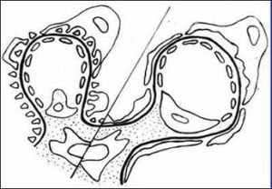 先天性腎病綜合徵 先天性腎病綜合徵