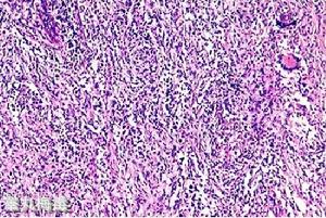 先天梅毒性肝硬化 先天梅毒性肝硬化