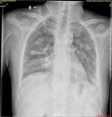 尿毒症肺炎 尿毒症肺炎