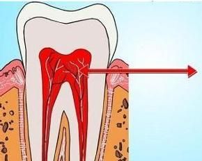 牙本質過敏 牙本質過敏