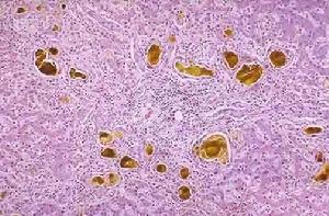 先天性肝內膽管囊狀擴張症