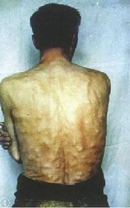 肌肉囊蟲病 肌肉囊蟲病