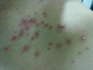 急性濕疹 急性濕疹