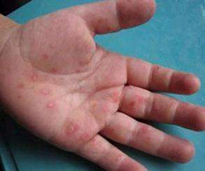 新生兒埃可病毒感染