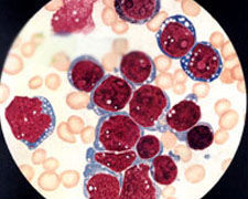 急性淋巴細胞性白血病