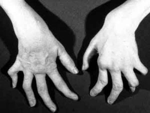 癌腫性關節炎 癌腫性關節炎