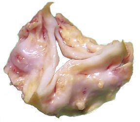 Duroziez征 Duroziez征