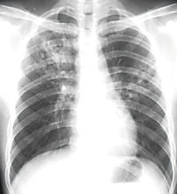 肺熱圖片