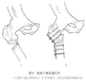 （圖）髖關節結核病