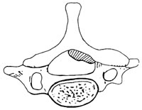 頸椎黃韌帶骨化症