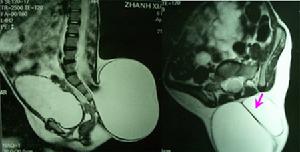 脊膜膨出與脊膜脊髓膨出