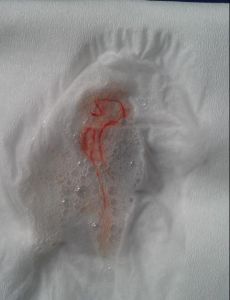 耳殼流痰病 耳殼流痰病