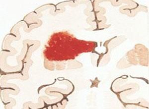 腦葉出血 腦葉出血