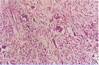 （圖）組織細胞纖維瘤