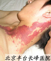 頸部血管瘤圖片