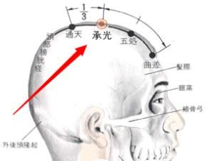 承光穴 承光穴