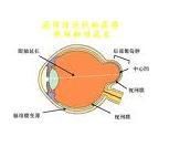 病理性近視 病理性近視