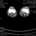膝關節平掃 膝關節平掃