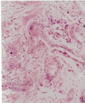 混合性結締組織病