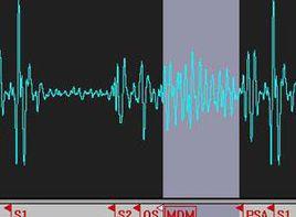 第三心音奔馬律 第三心音奔馬律