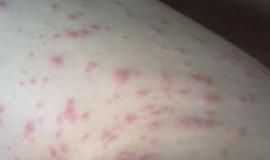 瀰漫性丘疹 瀰漫性丘疹