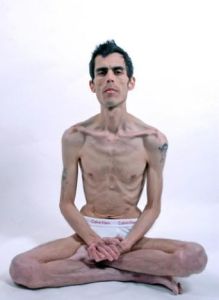 神經性厭食症 神經性厭食症