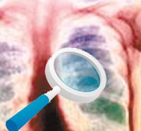 血行播散型肺結核