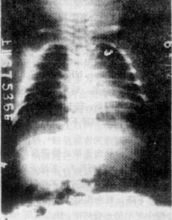 急性肺栓塞X光片