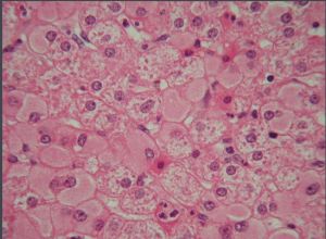 毛玻璃樣肝細胞