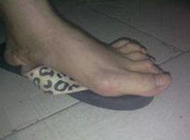 發熱伴關節腫痛 發熱伴關節腫痛