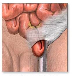 老人腹股溝斜疝